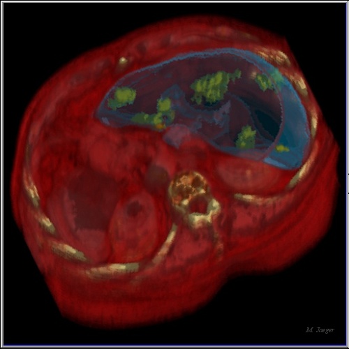 C2_Medical2.jpg - Ray traced CT scan reconstruction. Liver with tumoral tissues extrated. CT scan courtesy of Saint Eloi Hospital, Prof. JM Bruel & H. Joyeux. // CHU Saint Eloi & Centre anti Canceraux Val d'Aurelle, Montpellier - Cirad AMAP // 1989