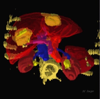 Med_Cancer05.jpg - Ray traced CT scan reconstruction. Liver with tumoral tissues extrated. CT scan courtesy of Saint Eloi Hospital, Prof. JM Bruel & H. Joyeux. // CHU Saint Eloi & Centre anti Canceraux Val d'Aurelle, Montpellier - Cirad AMAP // 1989