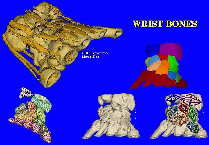 ApCarp02.jpg - Study on Wrist Bones, Maturation, Orientation. CT scan courtesy of Lapeyronie Hospital, Dr C. Cyteval and Dr Canovas. // CHU Lapeyronie, Montpellier - Cirad AMAP // 1993-1994.