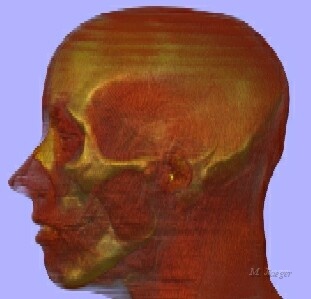 Asym03_LeftBis.jpg - Study on 3D Head CT scan raytracing. View 2. (muscles and bones)  CT Scan courtesy of Clinique Pasteur, Toulouse, Dr. J. Treil. // Clinique Pasteur, Toulouse - LIAMA-CASIA // 2002