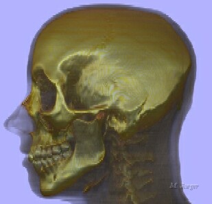 Asym03_LeftQuar.jpg - Study on 3D Head CT scan raytracing. View 3. (skin and bones)  CT Scan courtesy of Clinique Pasteur, Toulouse, Dr. J. Treil. // Clinique Pasteur, Toulouse - LIAMA-CASIA // 2002