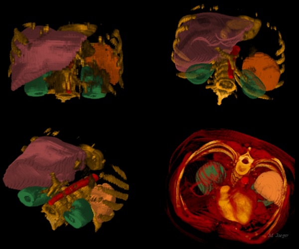 C2_FoieVues.jpg - Four CT Scan reconstructions of abodmen, with Aorta, Liver and kidney extracted. CT scan courtesy of Montpellier Saint Eloi Hospital, Prof. J. Treil & H. Joyeux. // CHU Saint Eloi & Centre anti Canceraux Val d'Aurelle, Montpellier - Cirad AMAP // 1989